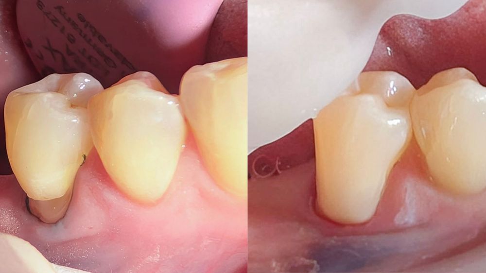 Composite Bonding for Receding Gums Before and After (Case 1)